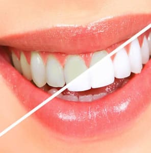 Tooth Color Restorations