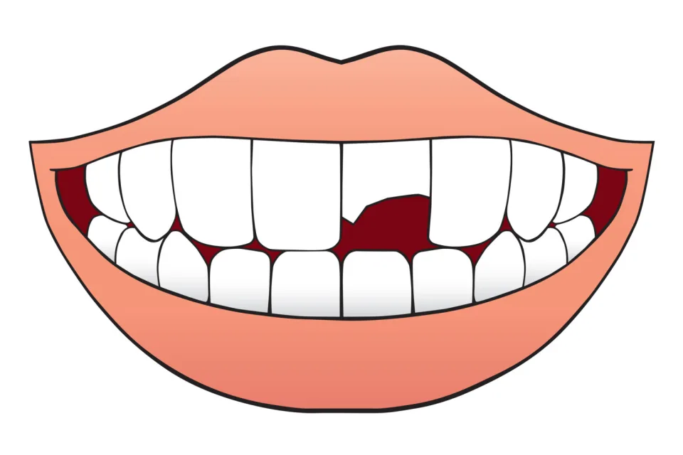 How to Fix Broken Teeth