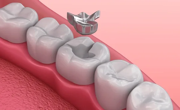 Best Dental Clinic in Bangalore for Cavity Fillings