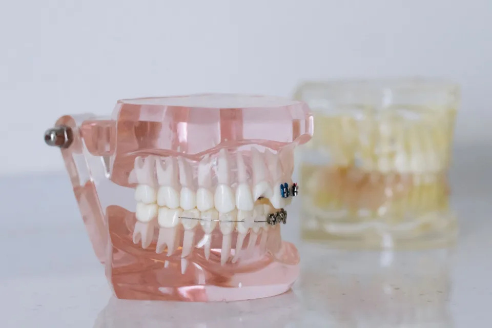 Detailed close-up of a dental model with braces, showcasing orthodontic equipment.